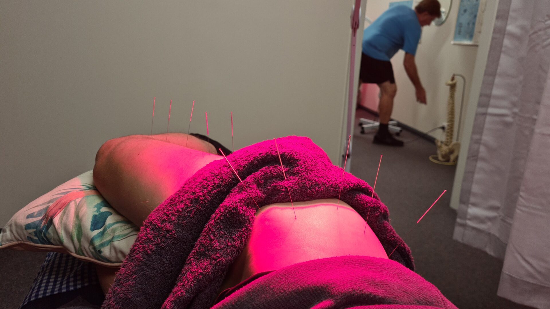 Dry Needling/Trockenes Nadeln